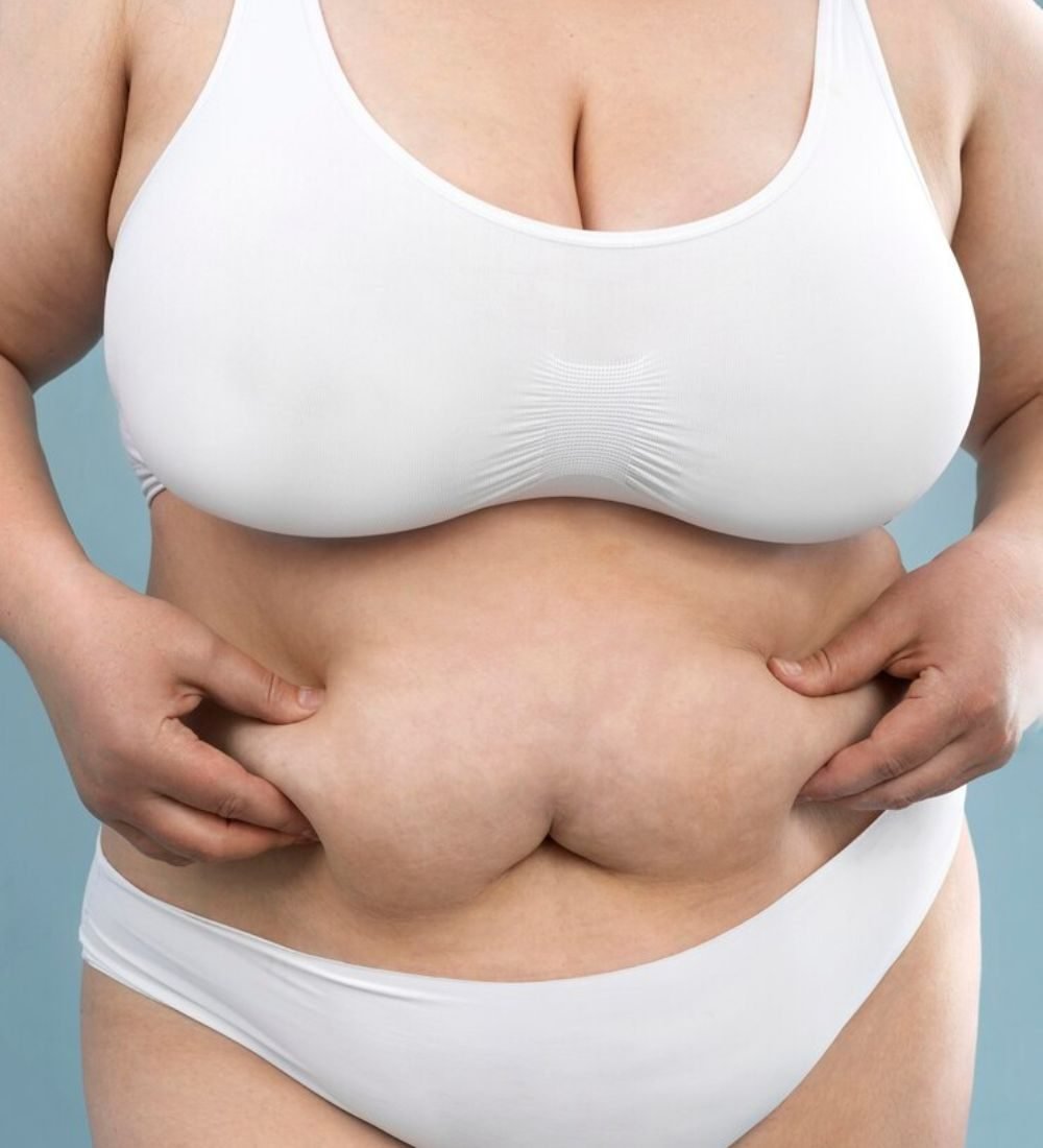 gordura-localizada-clinica de estetica