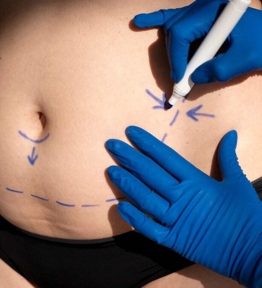 resultados-lipo-sem-corte