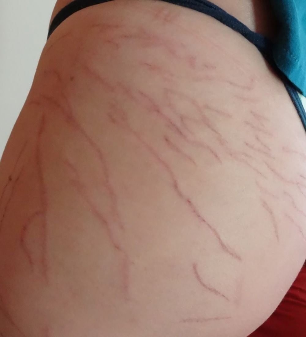 tratamento corporal para estrias