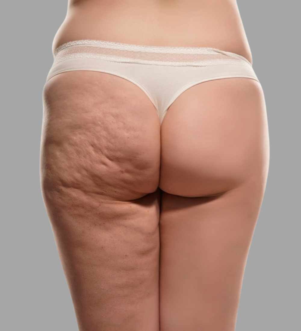 tratamento-para-celulites